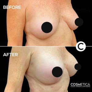 breast-augmentation-2